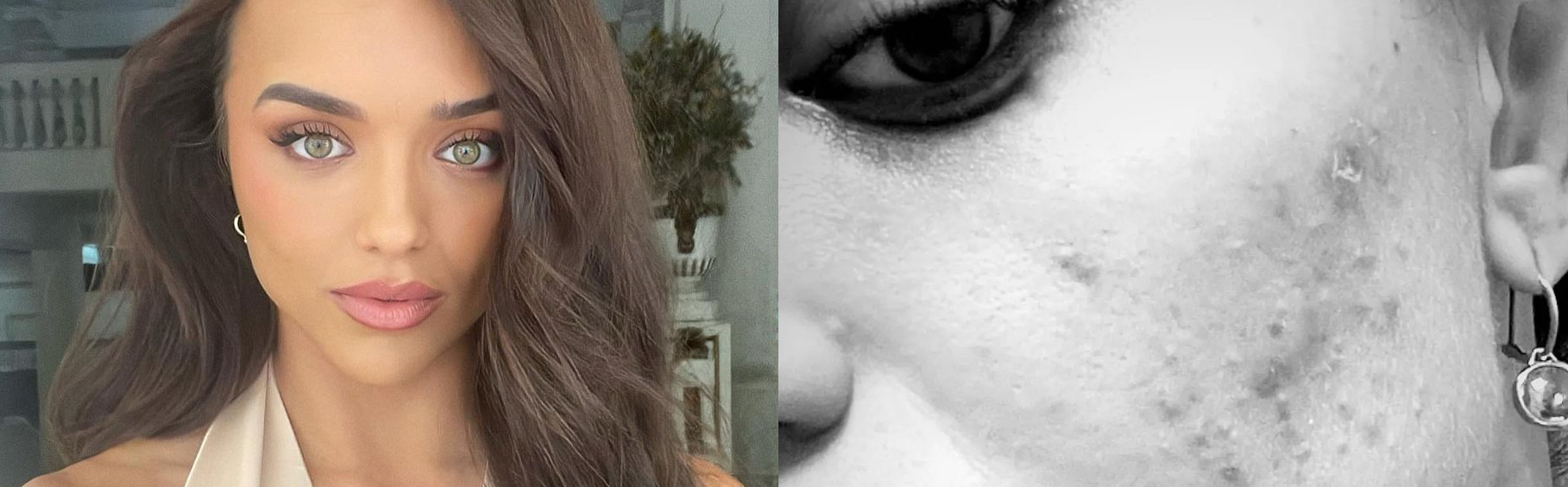 acne dieta