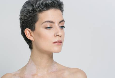 Vitiligo e estresse: Entenda a relação