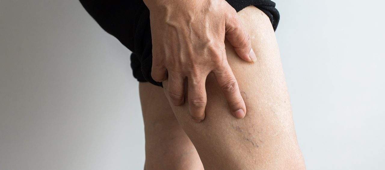 varizes não tratadas