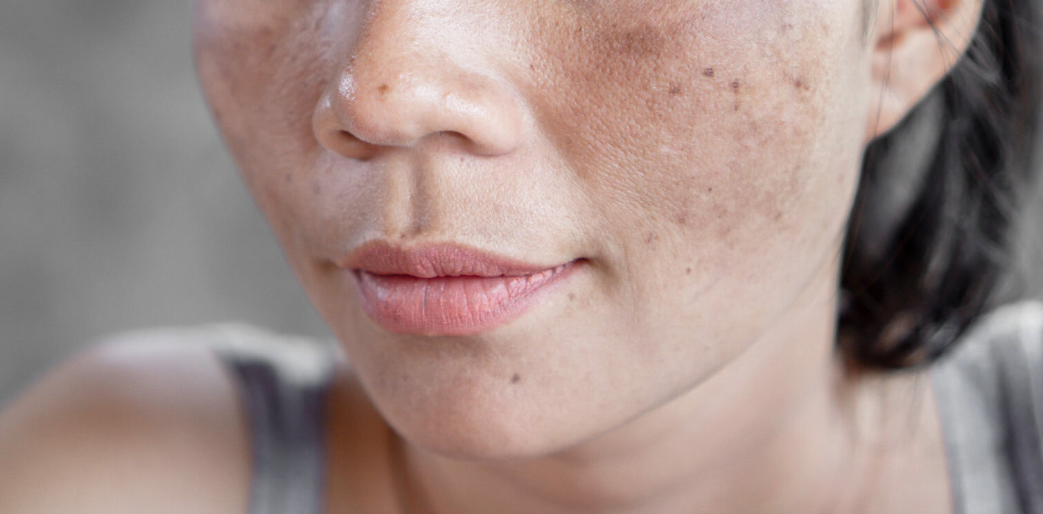 Melasma: O que é, tipos, cuidados e mais