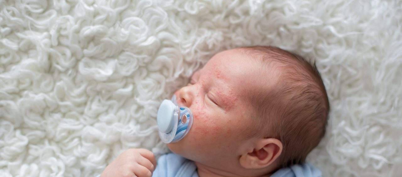 bebê com acne neonatal