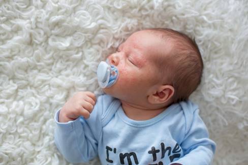 Acne neonatal: O que é e como tratar?
