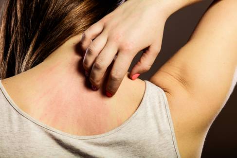 Brotoeja: saiba o que causa a dermatite e como tratá-la