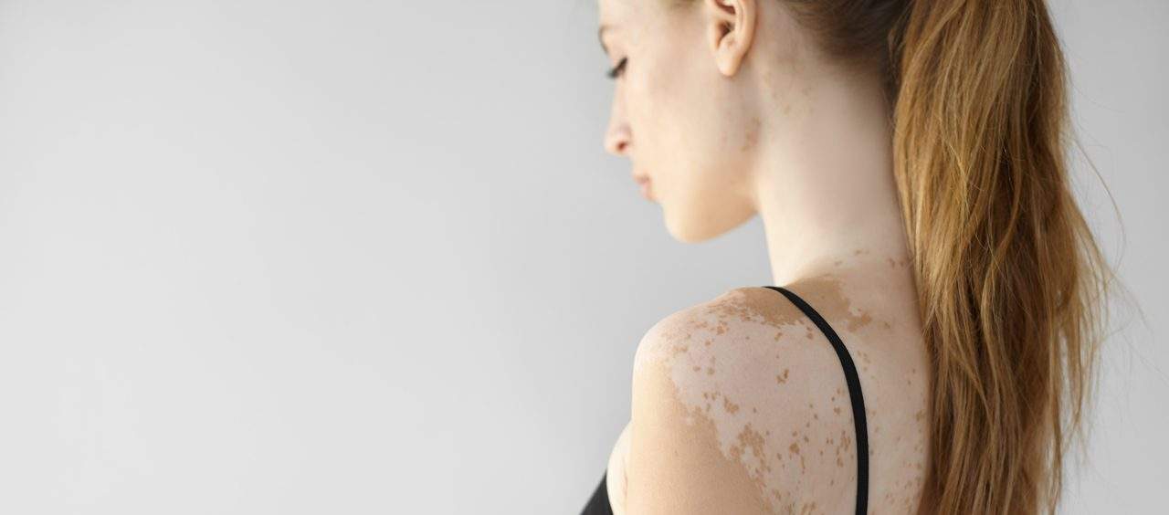 vitiligo
