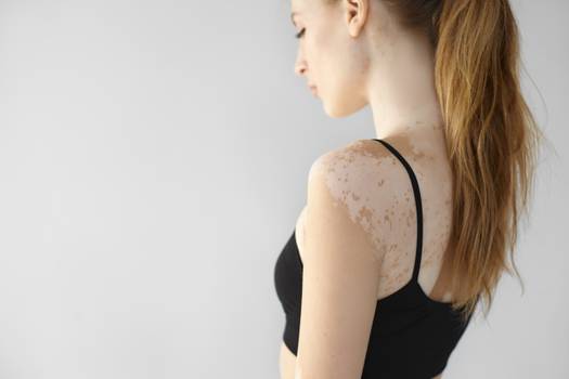 Vitiligo: o que é, sintomas, causas e tratamento