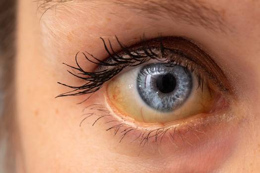 Olhos amarelos indicam problemas no fígado? Descubra o que dizem os especialistas
