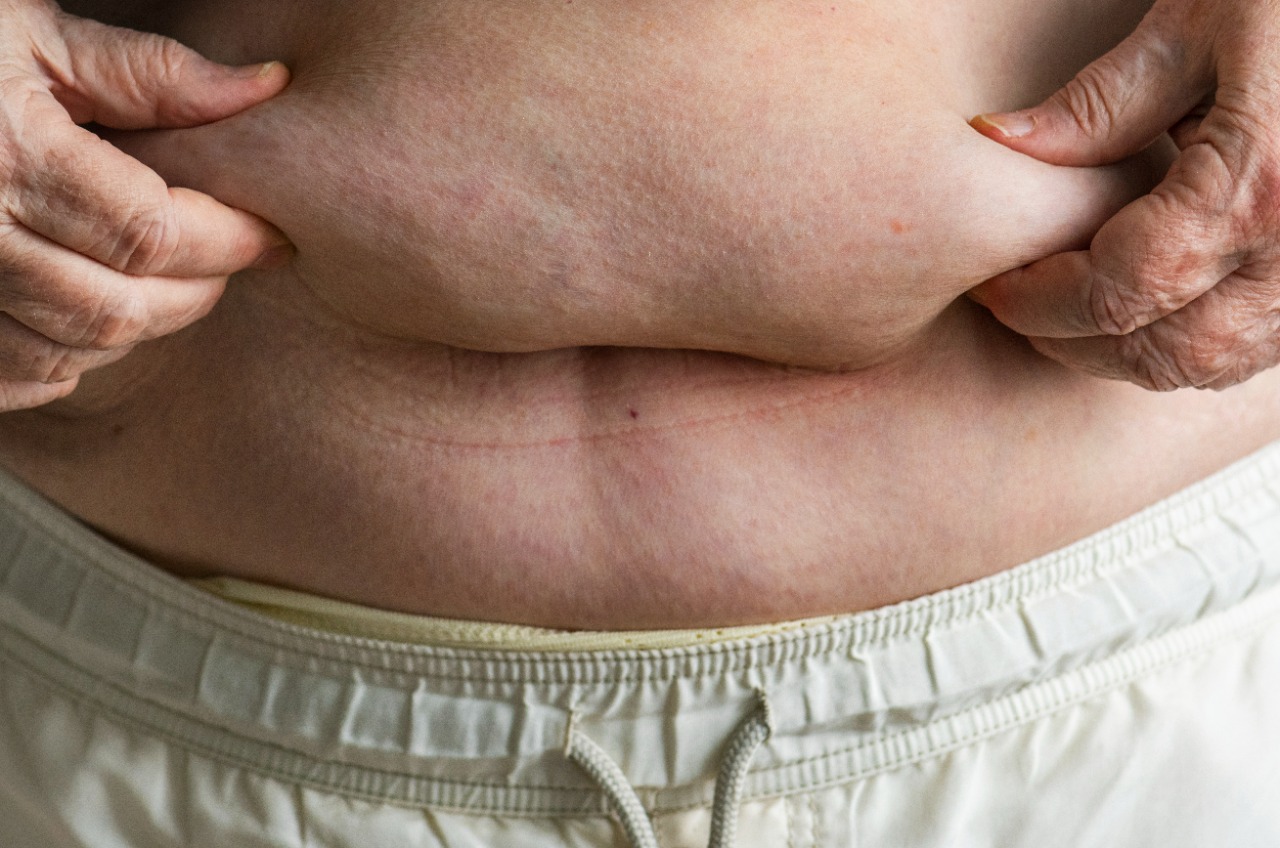 Obesidade grau 3: o que é, causas e prevenção