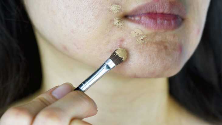 Maquiagem causa acne