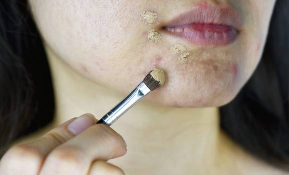 Maquiagem causa acne: mito ou verdade? Dermatologista esclarece