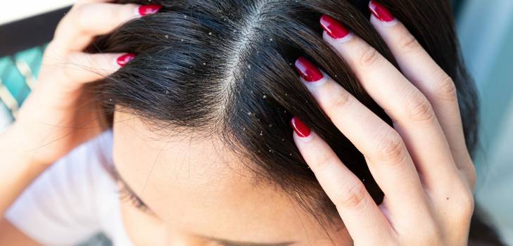 Shampoo anticaspa pode ressecar o cabelo: saiba como evitar