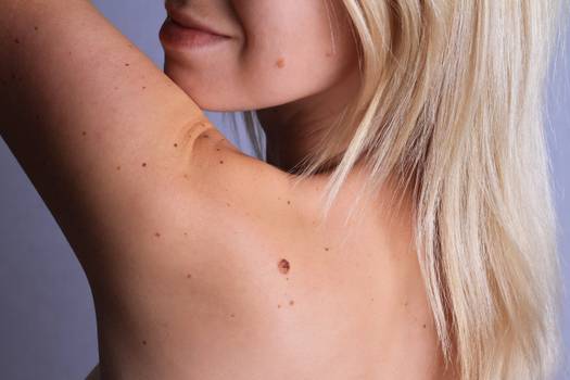 Como saber se uma pinta pode ser câncer de pele