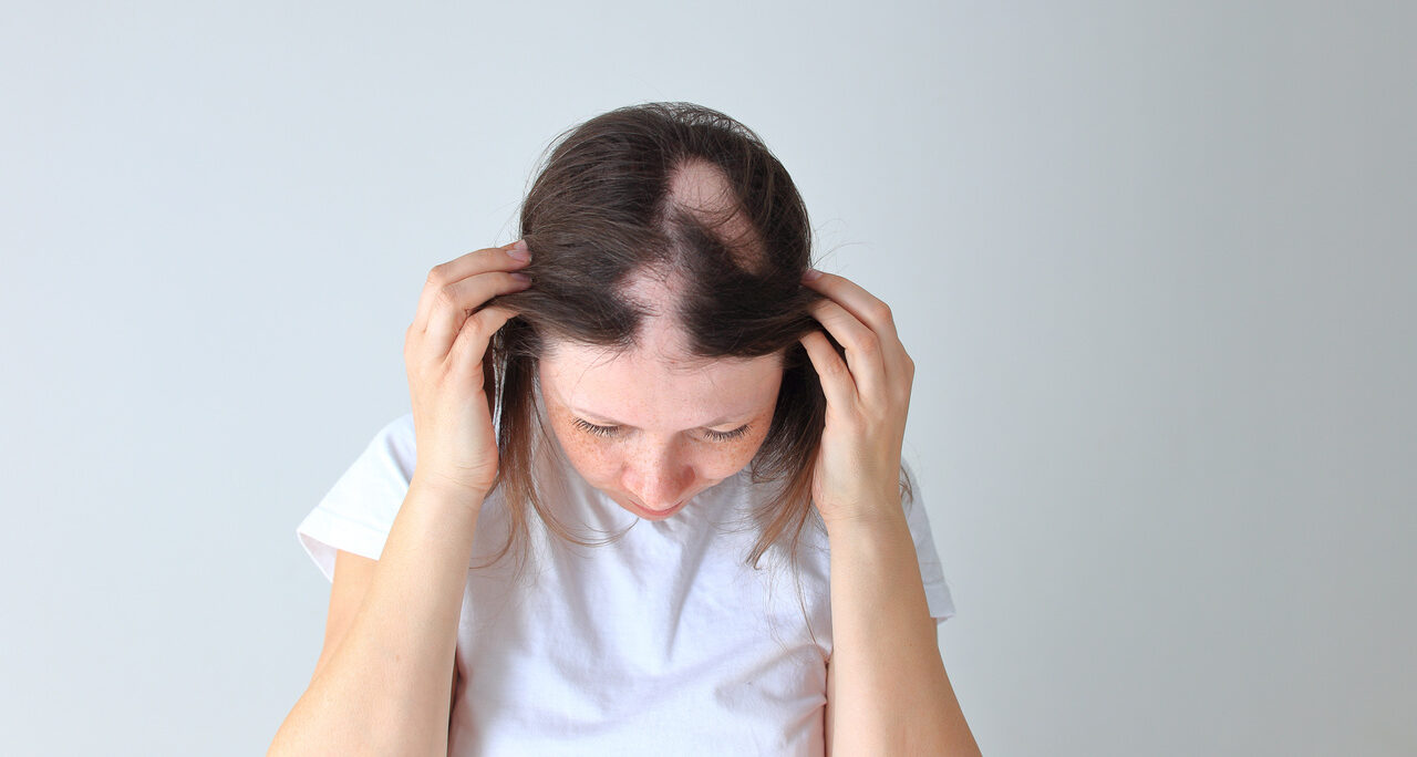 Quem tem alopecia areata pode fazer transplante capilar?