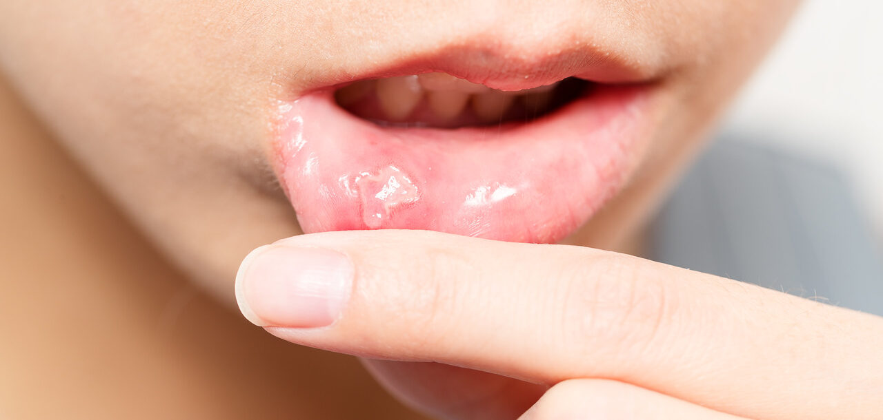 Afta: o que é, como tratar e prevenir esse problema? - Vitat