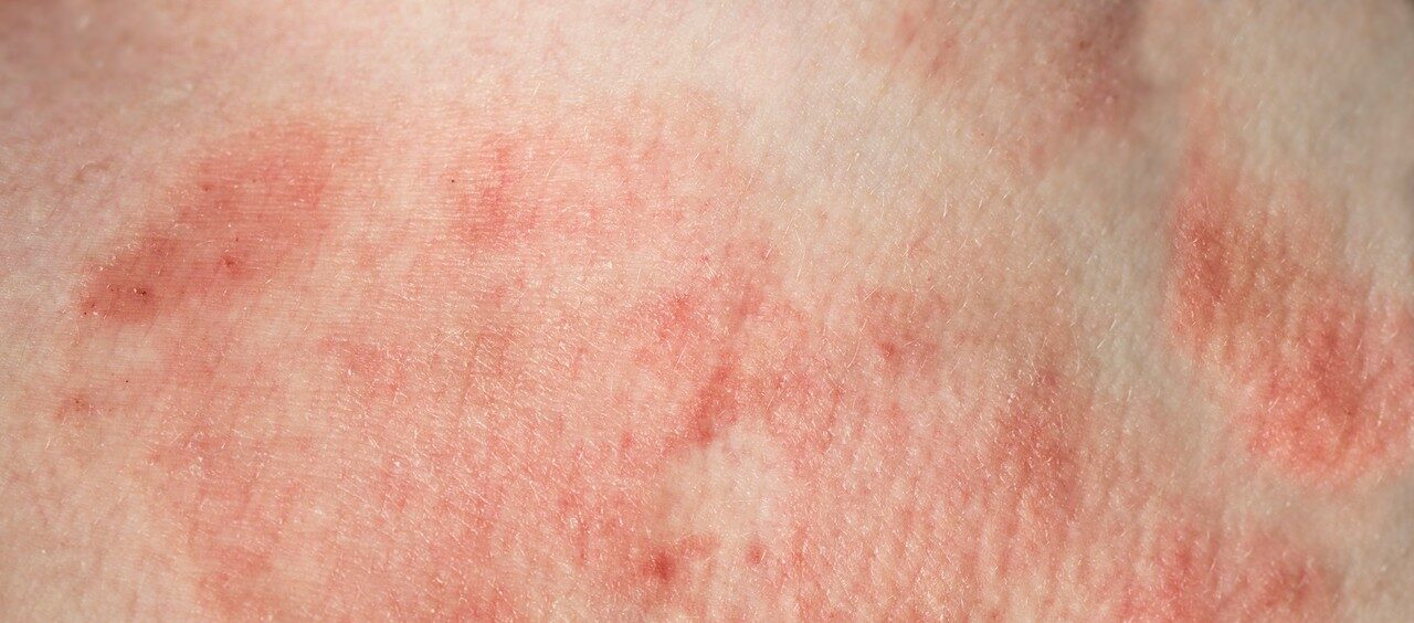 dermatite de contato