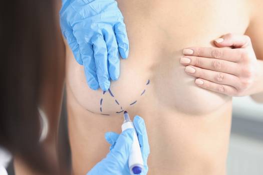 Mastopexia: para quem é indicada a cirurgia de redução das mamas?