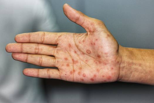 Sífilis: saiba tudo sobre a infecção e como se prevenir