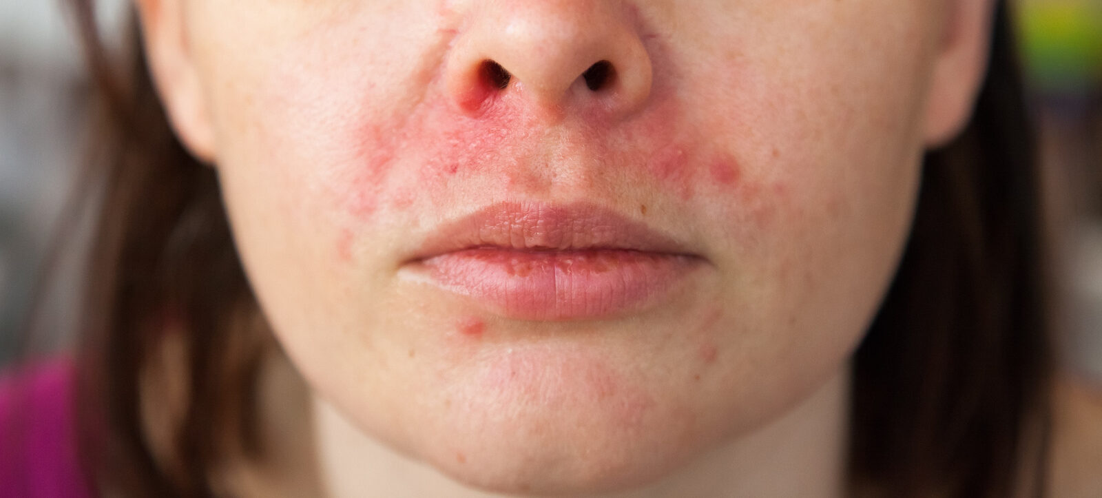 Dermatite perioral: o que é, causas, sintomas e tratamentos