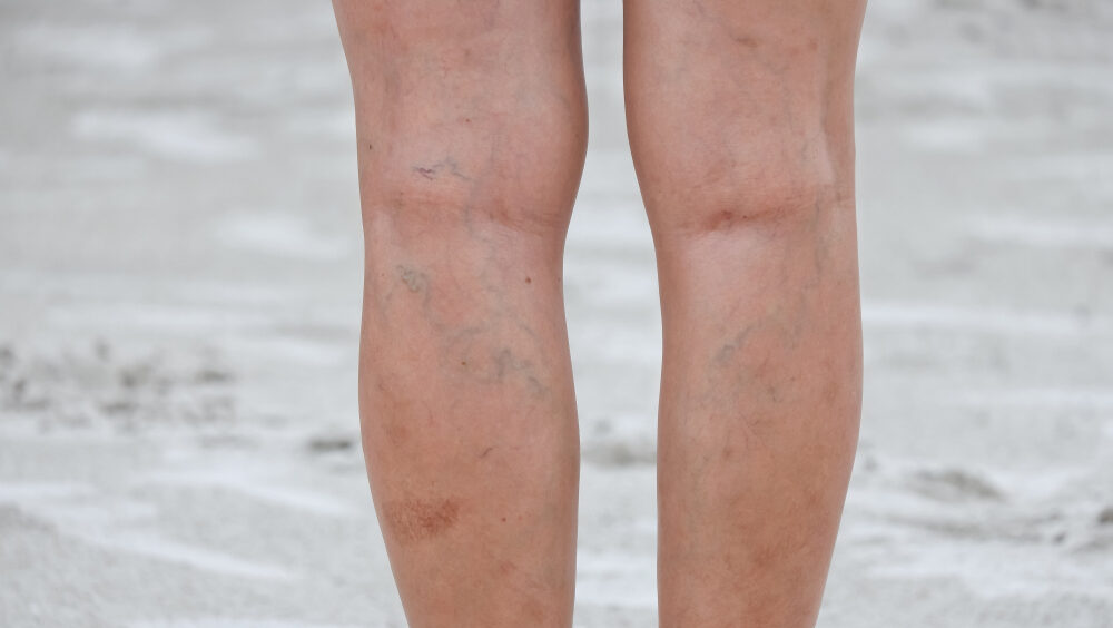 varizes em crianças