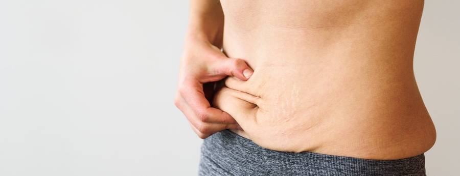Flacidez na barriga: O que fazer para diminuir