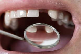 Agenesia dentária: o que é, sintomas, causas e tratamento