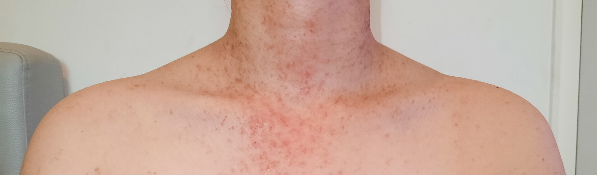 acne fúngica