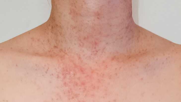 acne fúngica