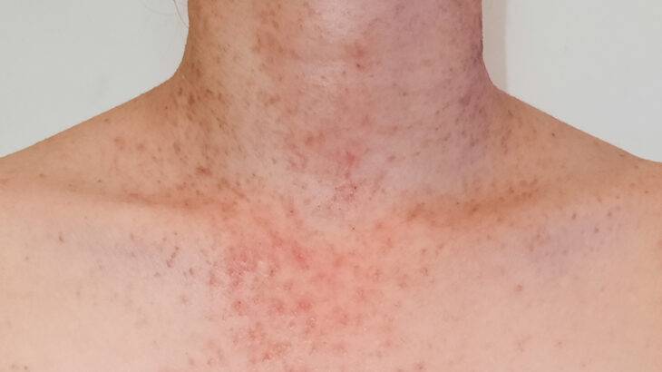 acne fúngica