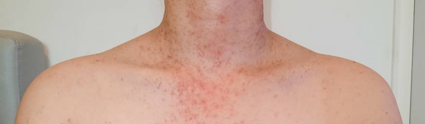 Acne fúngica: o que é, causas, sintomas e tratamentos