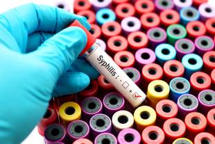 Exame VDRL: tudo o que você precisa saber sobre o teste de sífilis