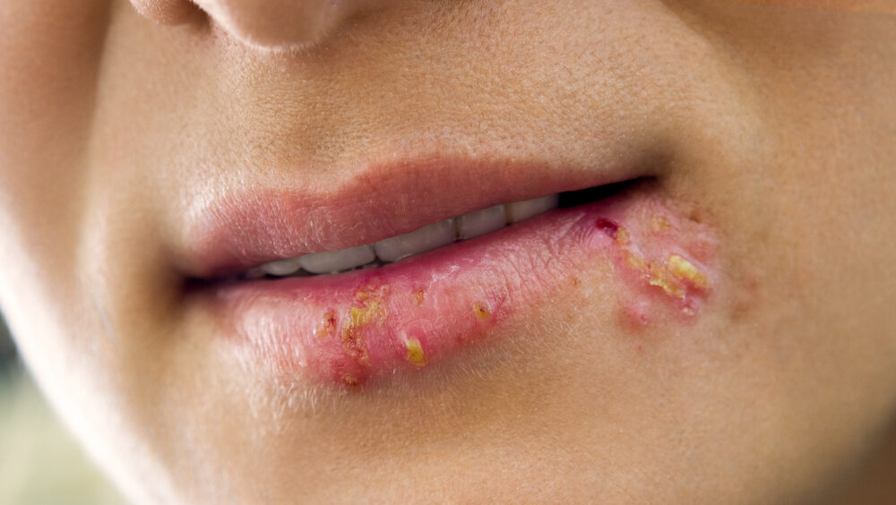 herpes labial