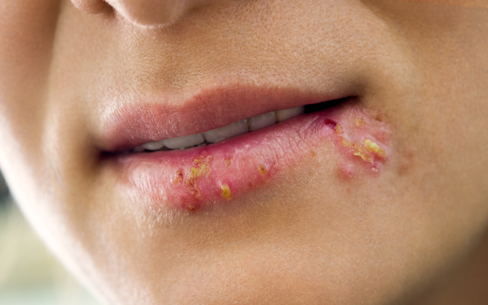 Herpes labial: o que é, sintomas, causas e tratamento - Vitat