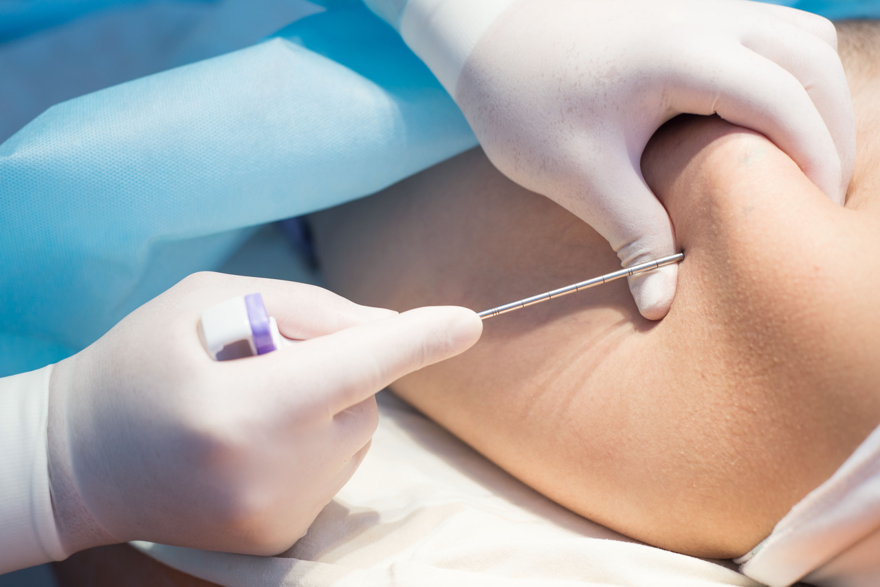 Mielograma: o que é, para que serve e como é feito