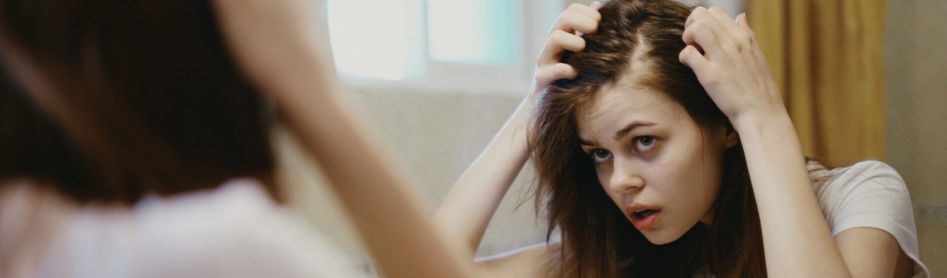 alopecia juvenil