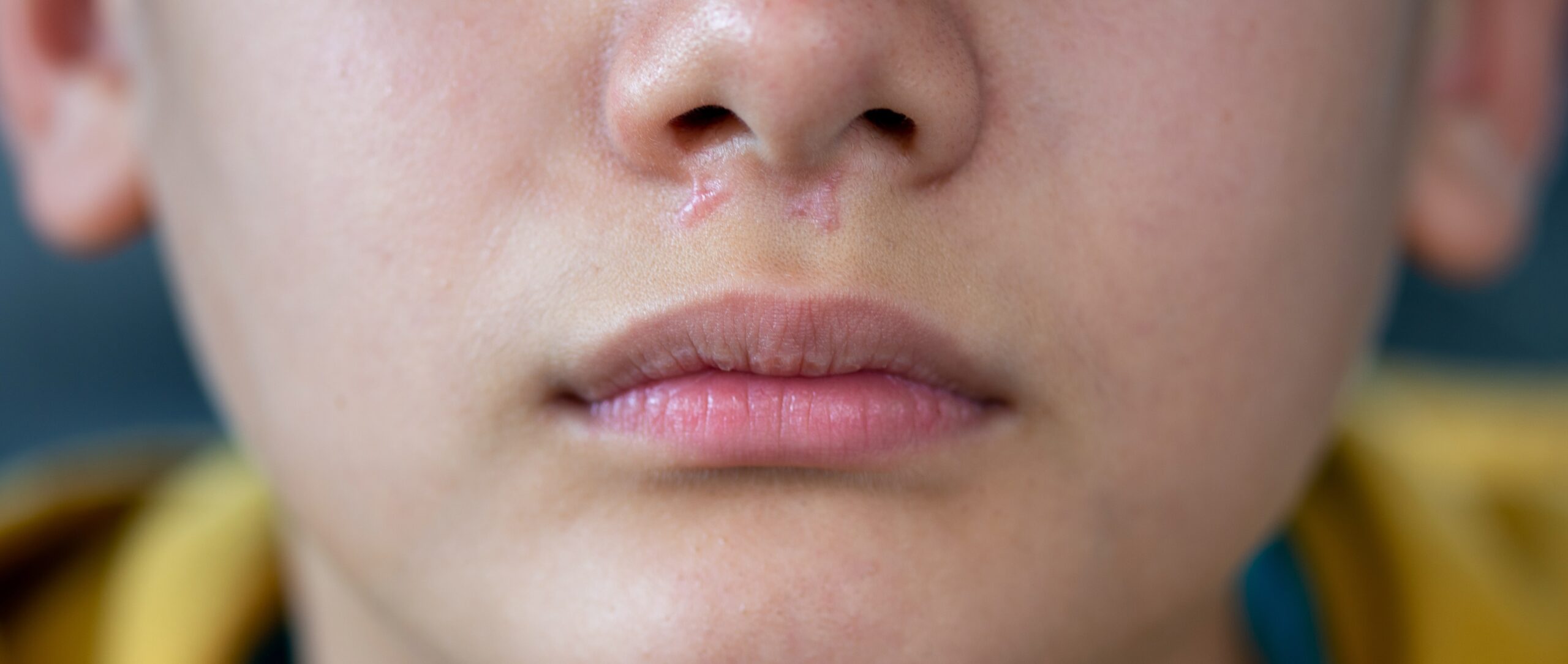 Queloide no nariz: tudo o que você precisa saber sobre o assunto