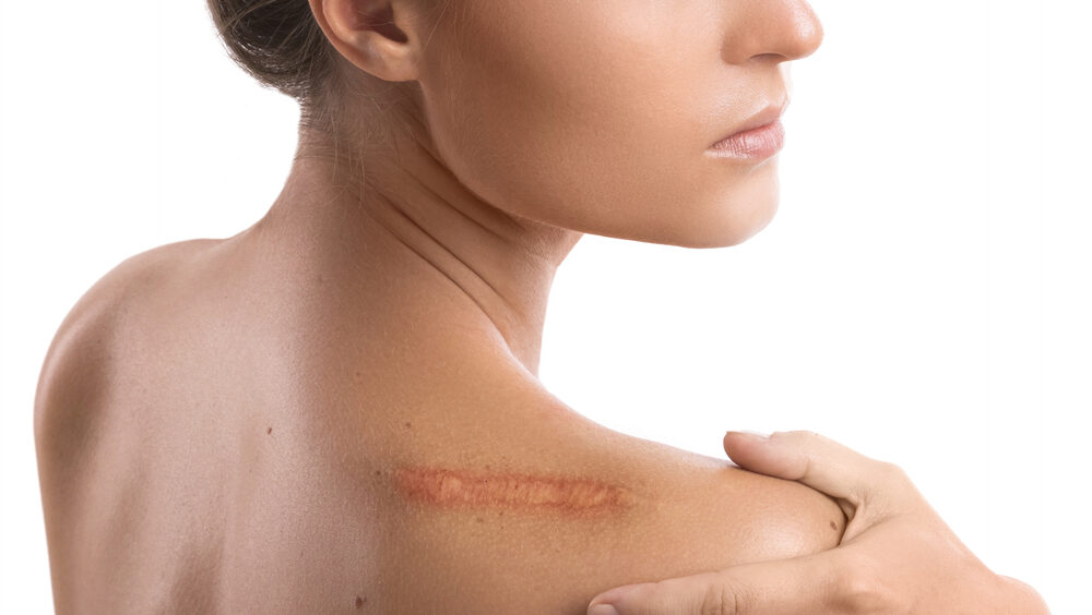 cirurgia para remover cicatriz