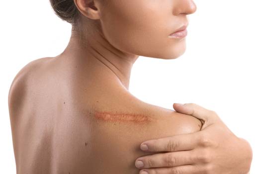 Cirurgia para remover cicatriz: como é feita e quem pode fazer