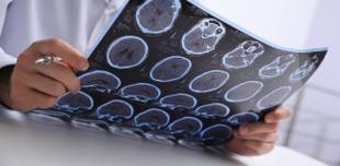 Incapacidade neurológica pode ter relação com esclerose múltipla