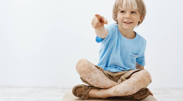 Vitiligo em crianças: o que é, principais tipos e tratamentos