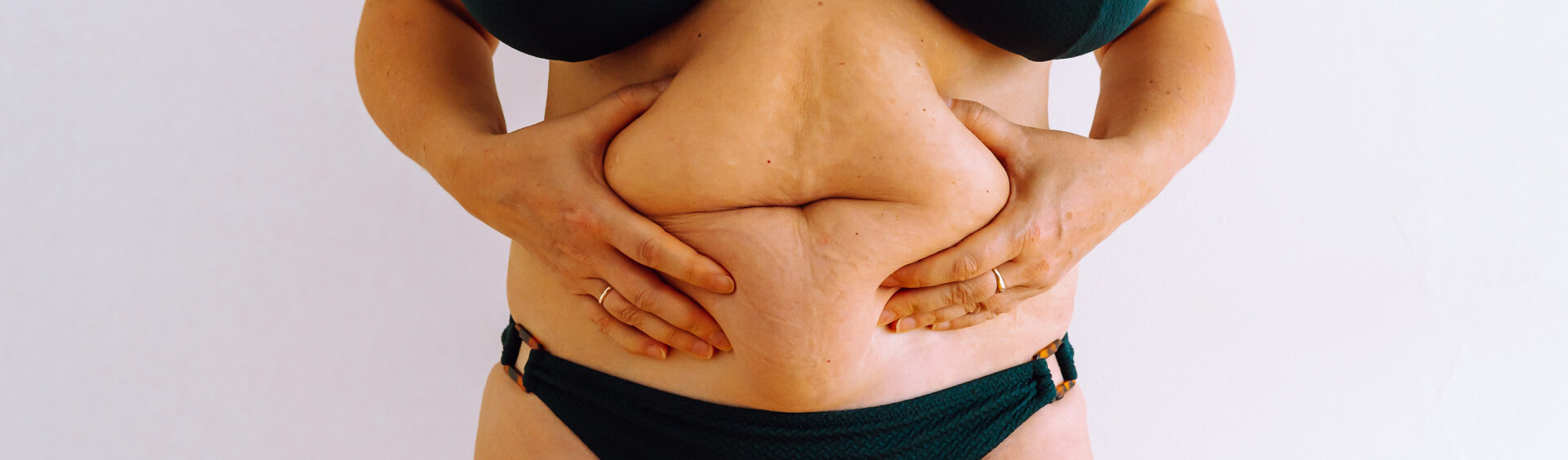 flacidez na barriga