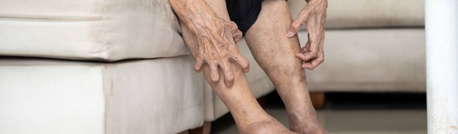 Dermatite ocre: o que é, causas, sintomas e tratamento