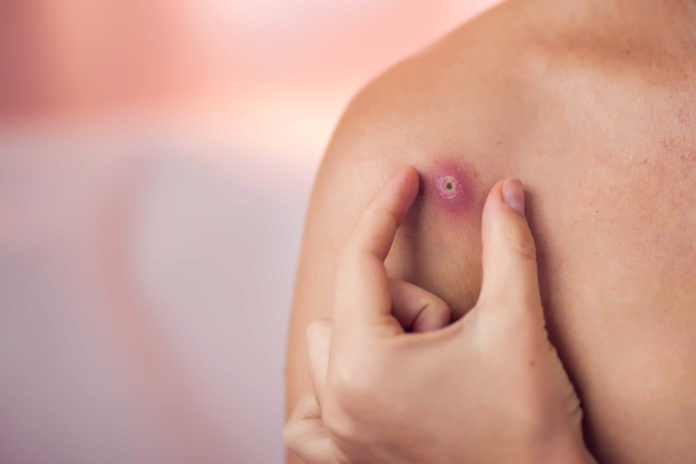 Carbúnculo: o que é, sintomas, tratamentos e causas