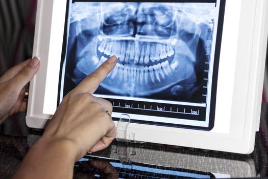 Raio X panorâmico odontológico: o que é e para que serve