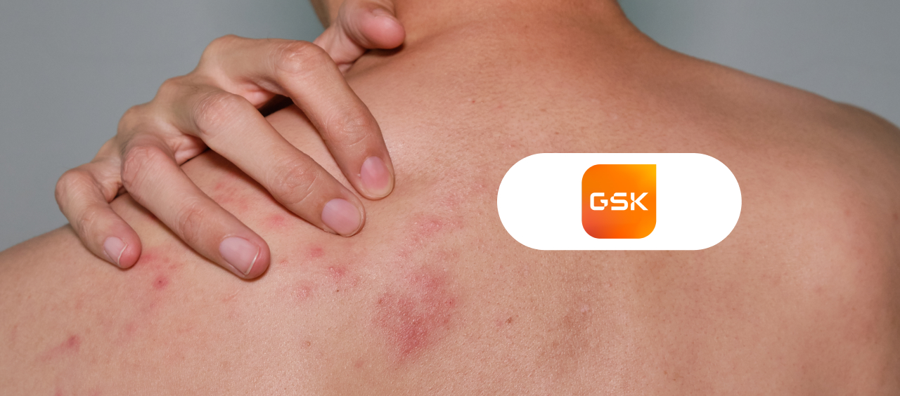 Herpes zoster saiba mais sobre a infecção e como se proteger Vitat