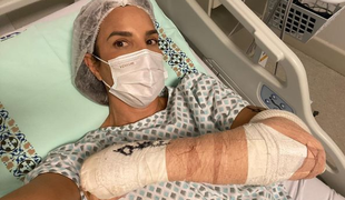 Ivete Sangalo é operada após fratura no antebraço; saiba como tratar