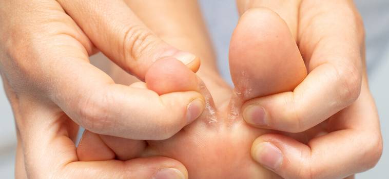 Micose no pé (frieira): o que é, sintomas e tratamento