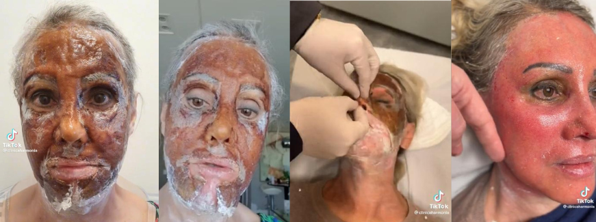 peeling de fenol