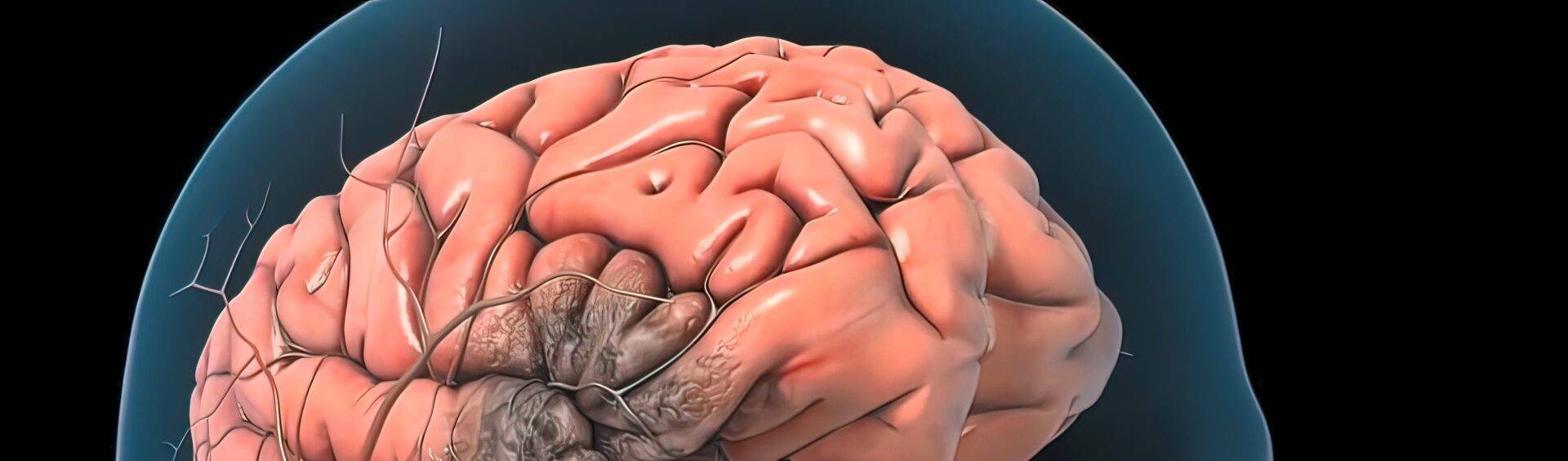 o que é aneurisma cerebral