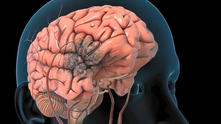 o que é aneurisma cerebral