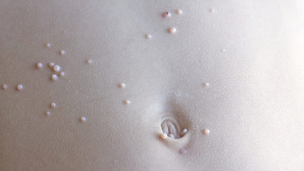 molusco contagioso