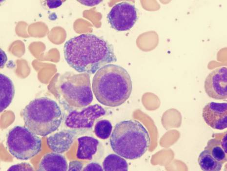Mielodisplasia: conheça o câncer que acomete as células-tronco